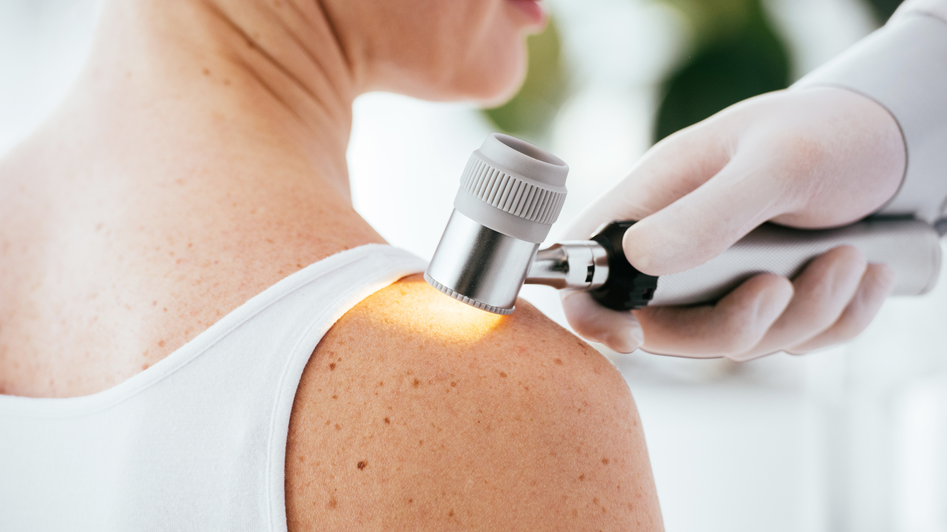 melanoma