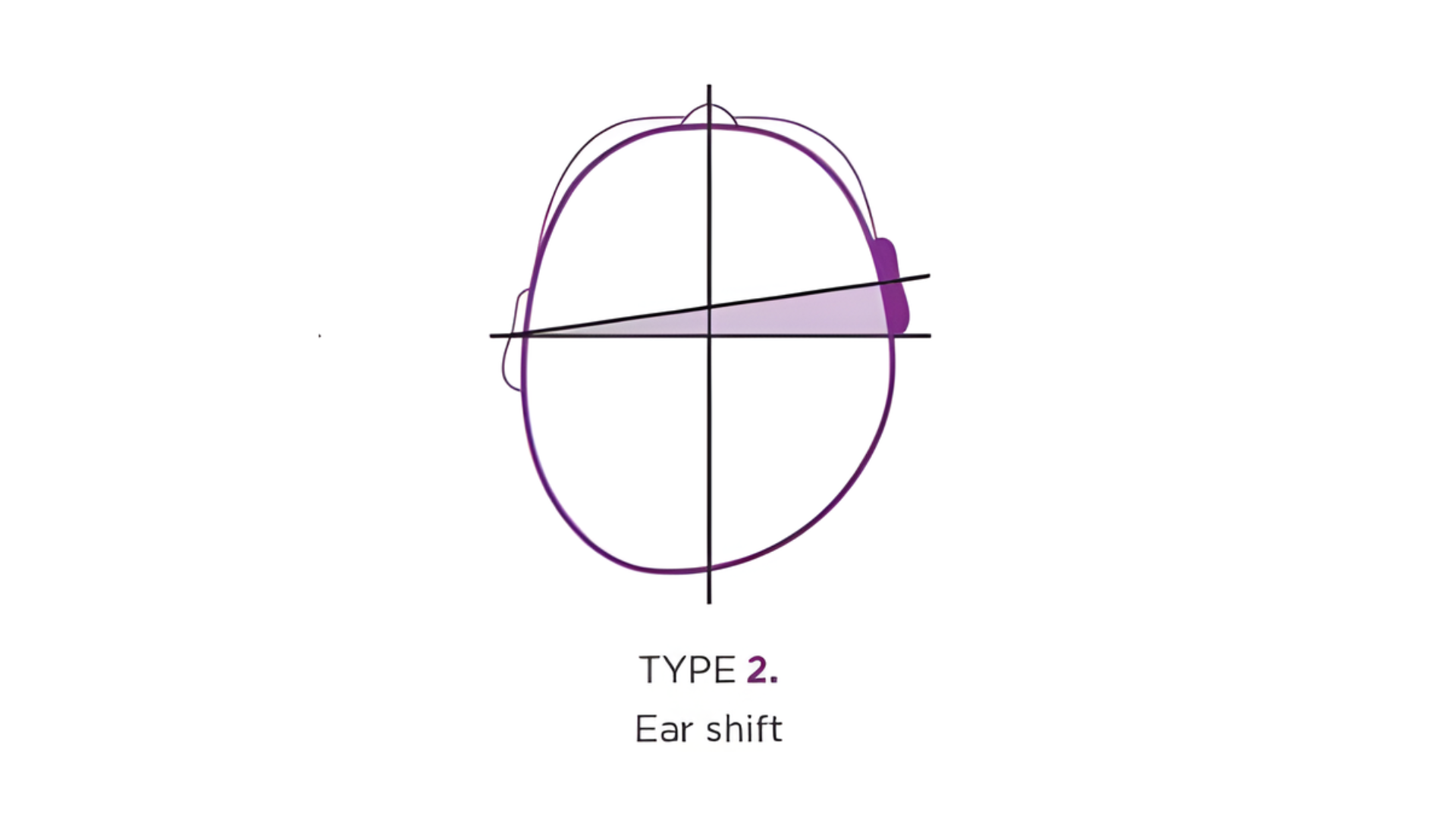 plagiocefalia-disturbi-uditivi