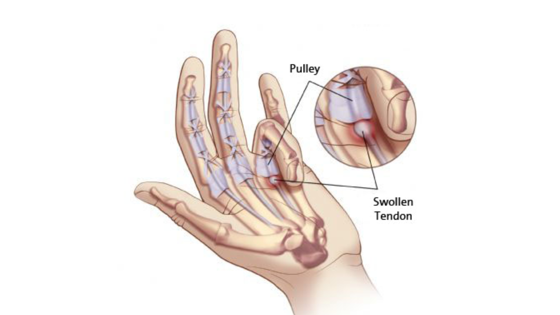 dito-a-scatto-trigger-finger-eom