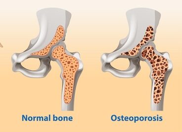 osteoporosi-