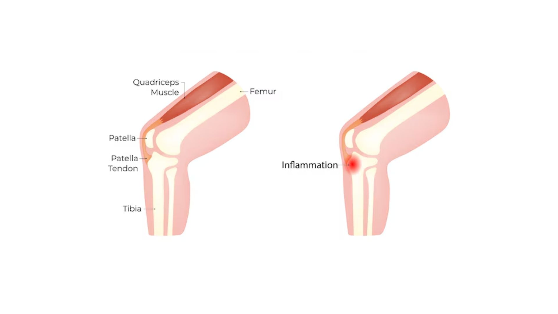 Sindrome di Osgood Schlatter