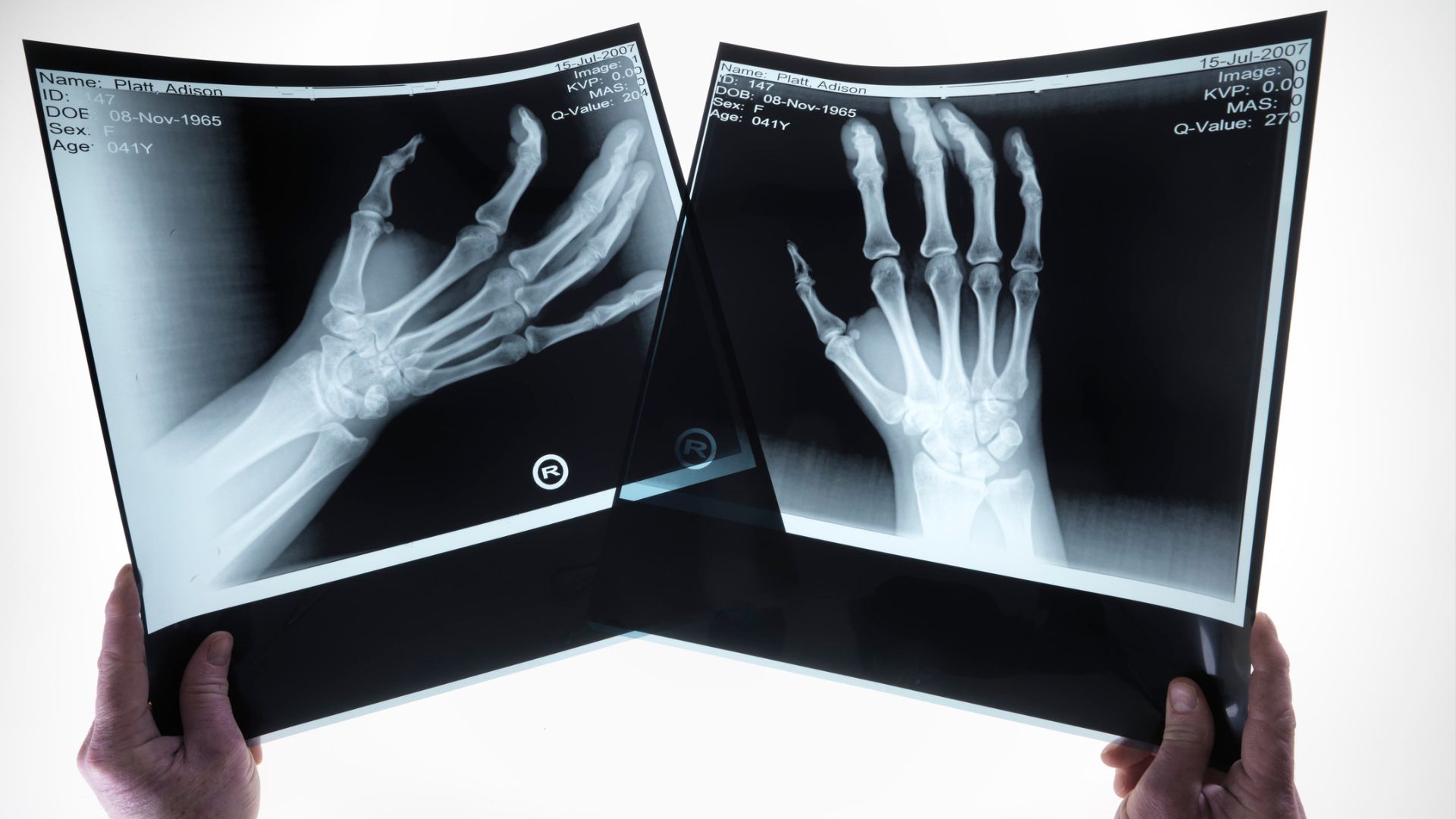 radiografia polso