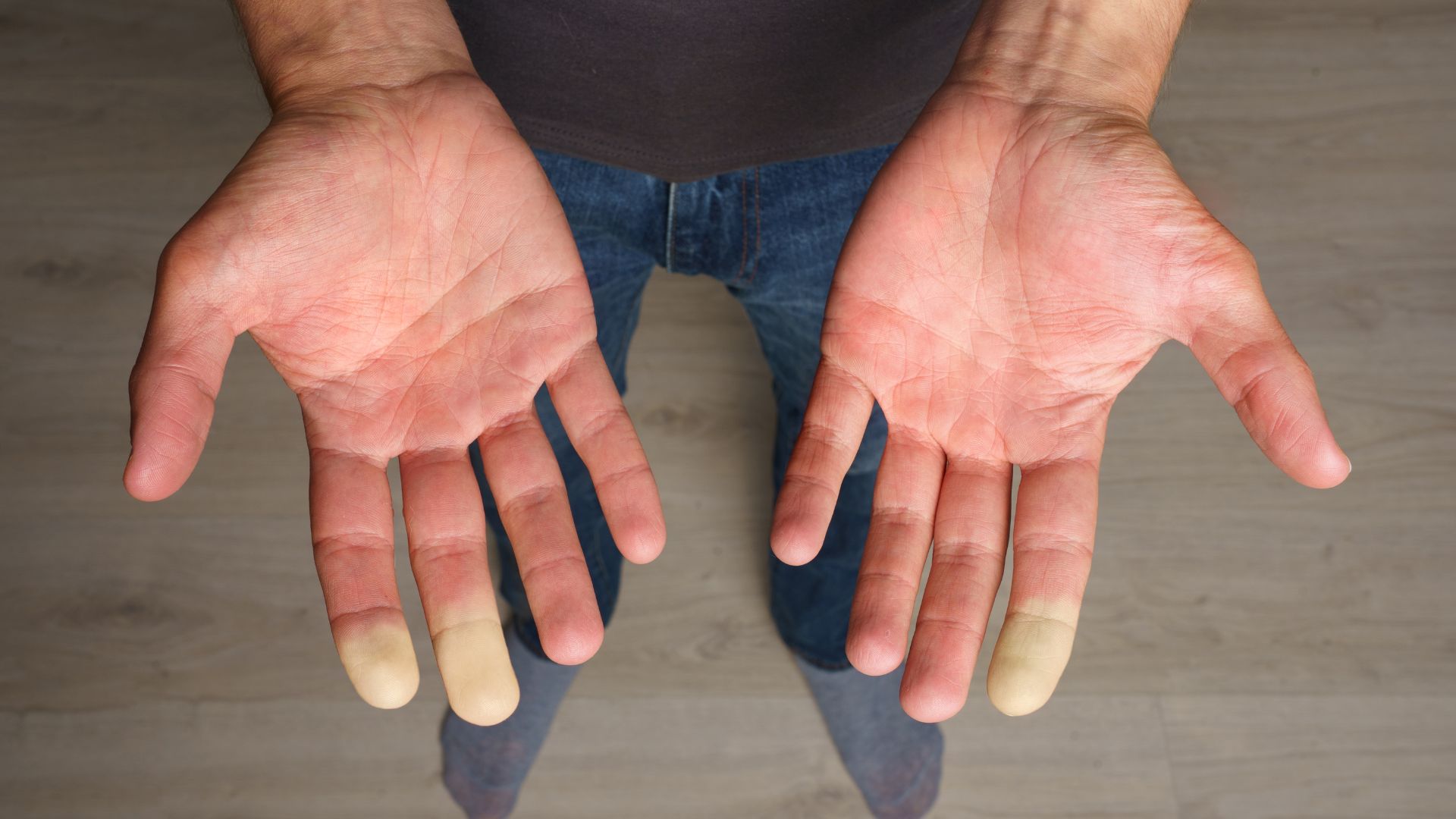 sindrome-raynaud